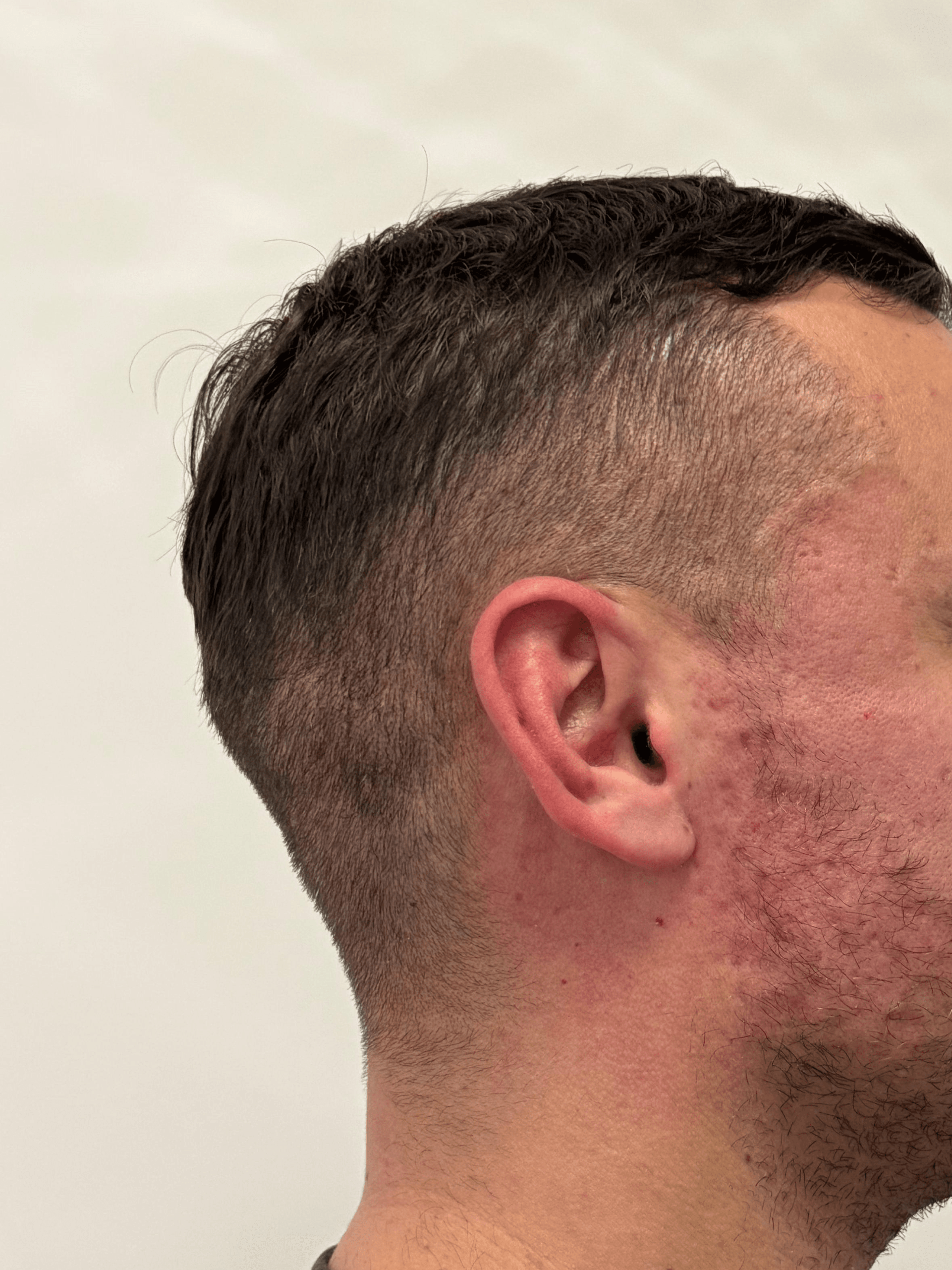 Antes: Bioestimulación colágena facial