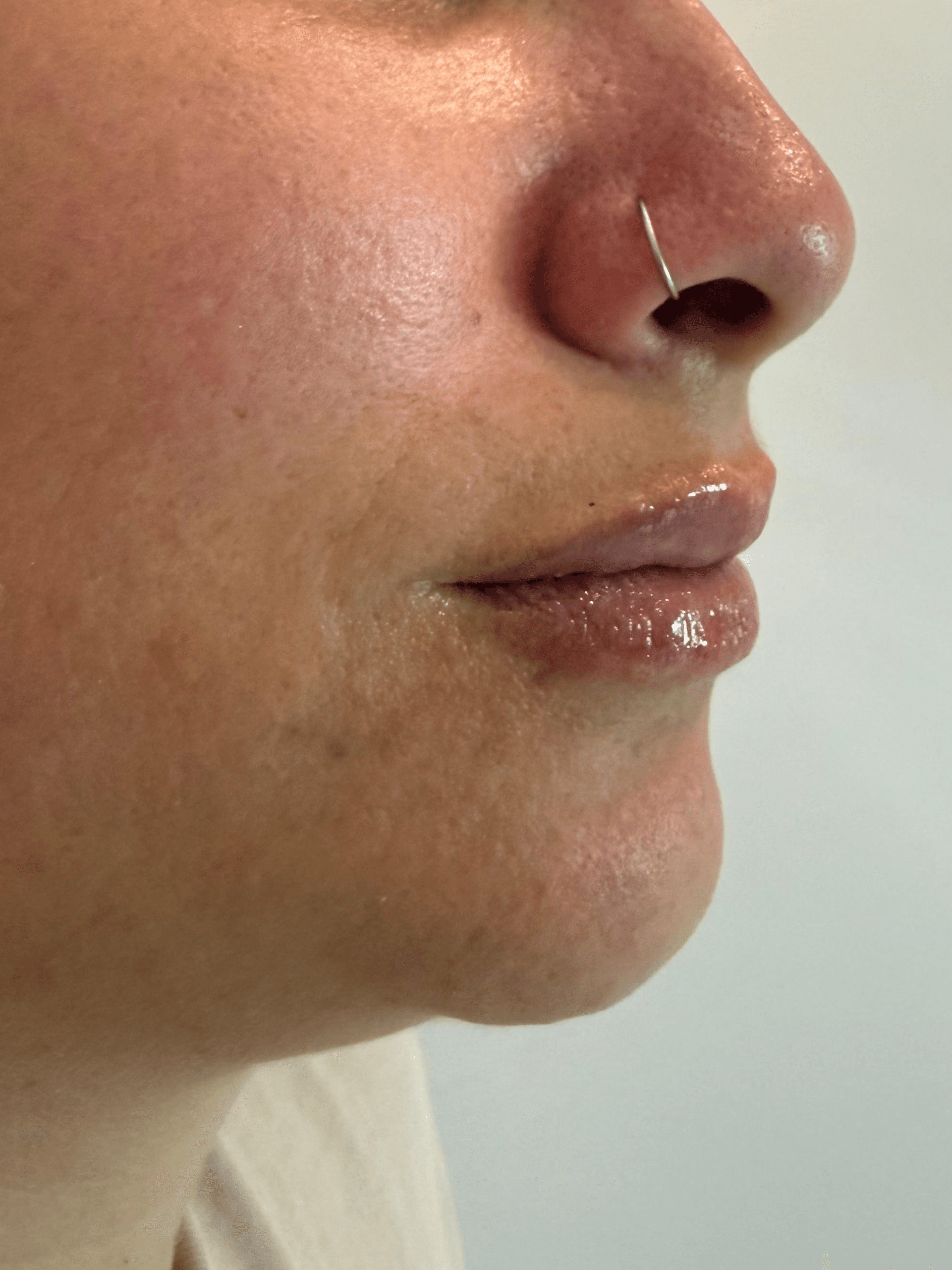 Después: Ácido Hialurónico en labios