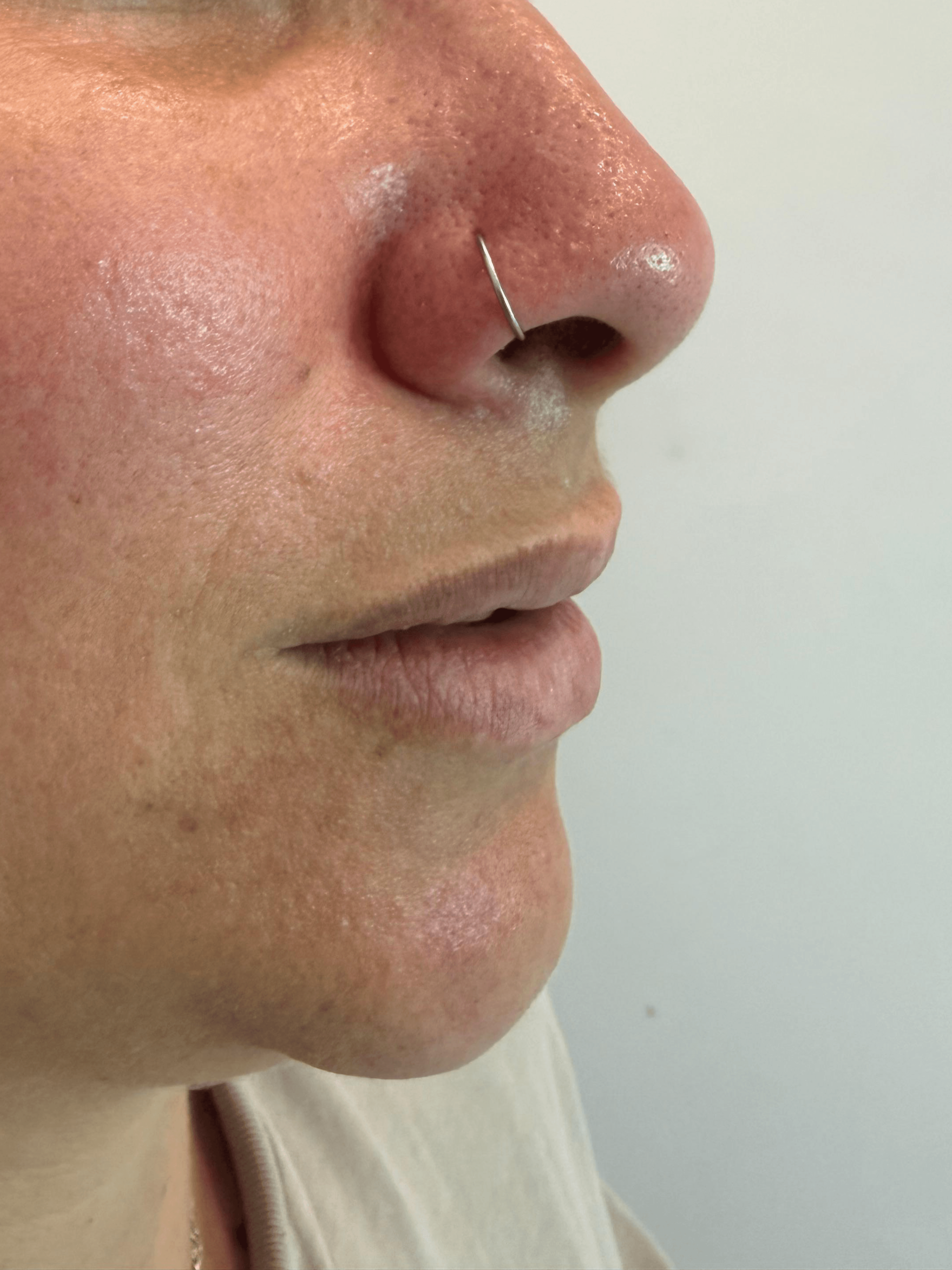 Antes: Ácido Hialurónico en labios